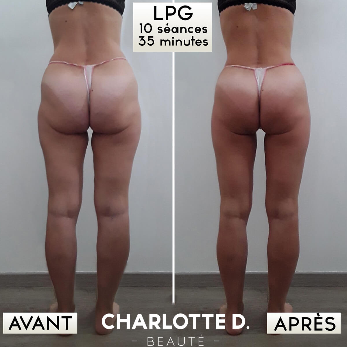 anti-cellulite